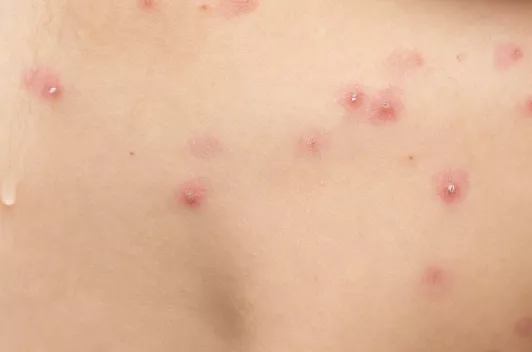 viruelamono