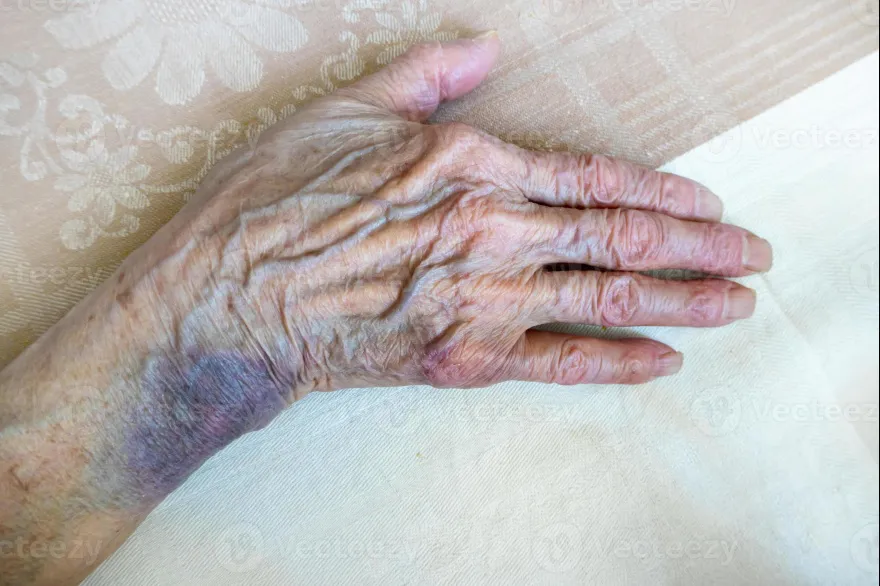 20240626084049_the_hand_of_an_elderly_woman_with_bruises_photo