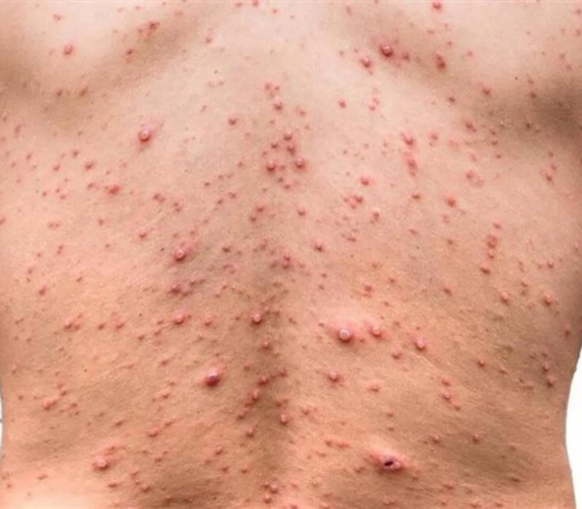 865396-viruelamono_0