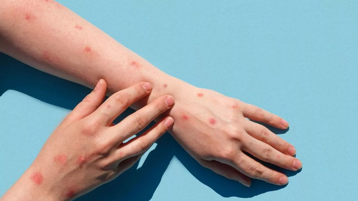 viruela-del-monojpeg